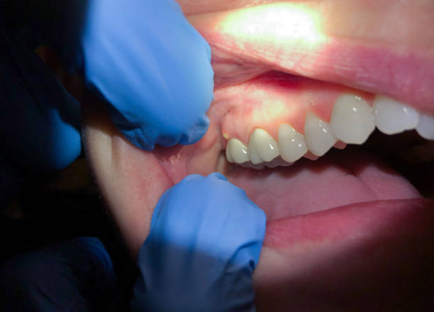 Best Broken or Chipped Tooth Repair in St Rose, LA