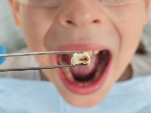 Best Knocked-Out Tooth (Avulsed Tooth) Treatment in St Rose, LA